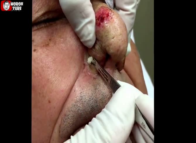 Video :Electrosurgery for rhinophyma, or a nose packed with pus